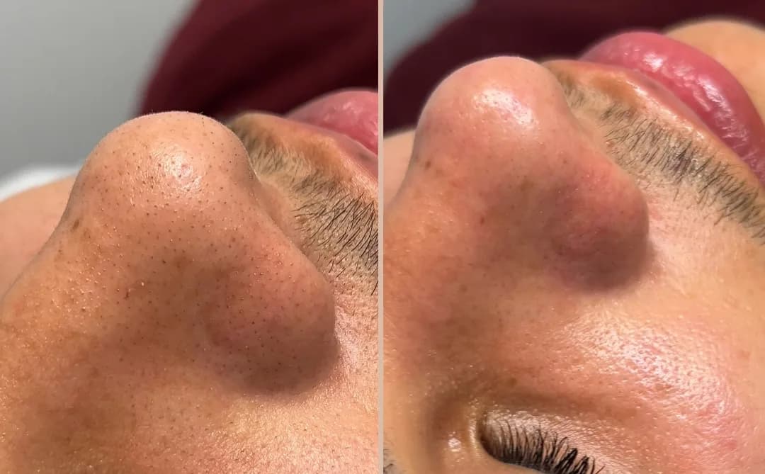 Professional facial treatment to even out skin tone after summer