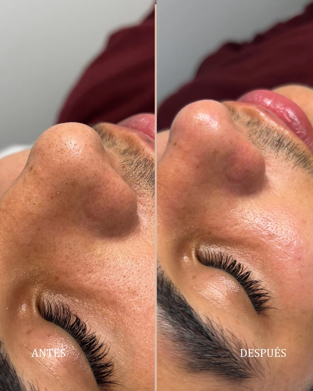 Tratamiento de Higiene Facial Profunda