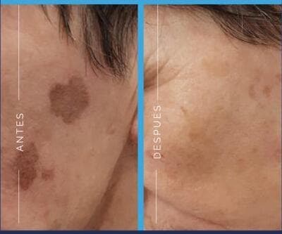 Láser Azul Exclusivo en La Cañada