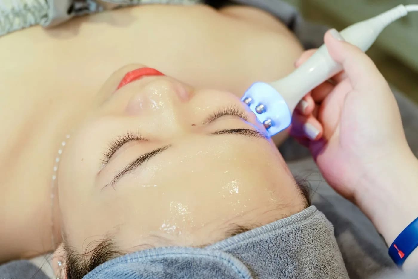 Facial radiofrequency treatment with a device in an aesthetic clinic