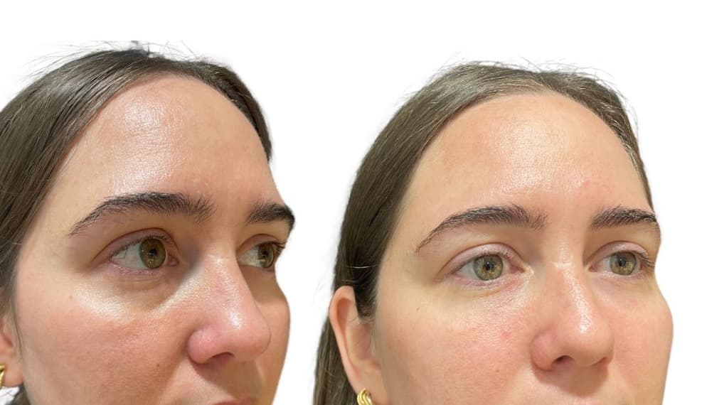 Tratamiento con Acido Hialuronico en Ojeras