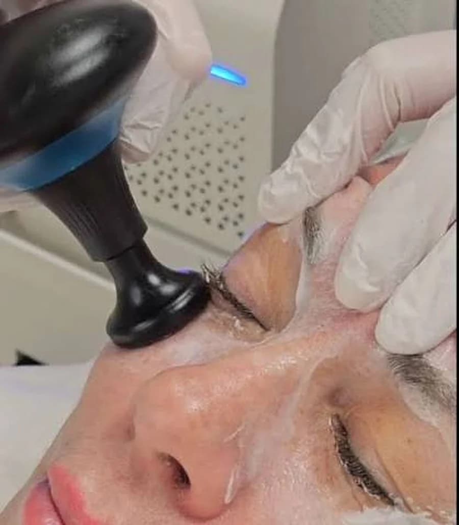 Facial radiofrequency session at Cambria Clinic